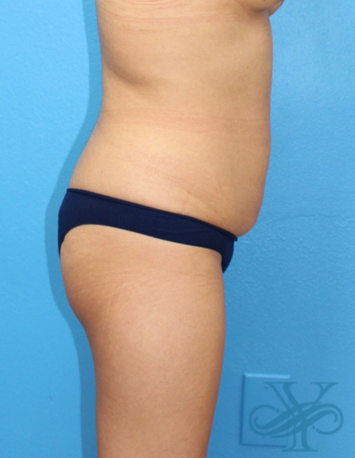 Before liposuction Dr. Yegiyants, Santa Barbara, CA