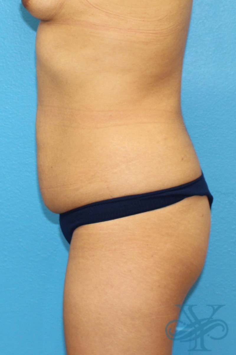 Before liposuction Dr. Yegiyants, Santa Barbara, CA