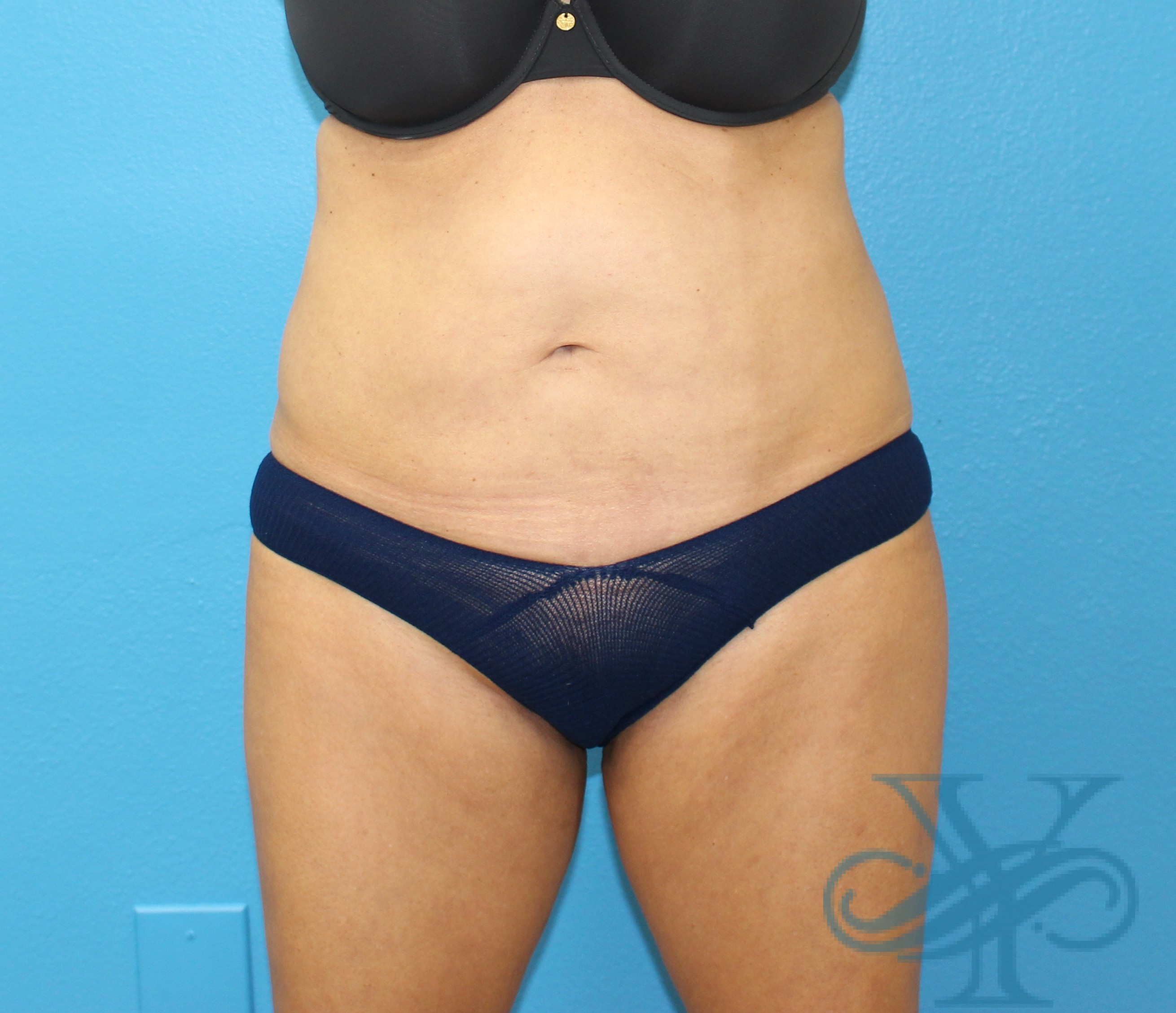 Before liposuction Dr. Yegiyants, Santa Barbara, CA