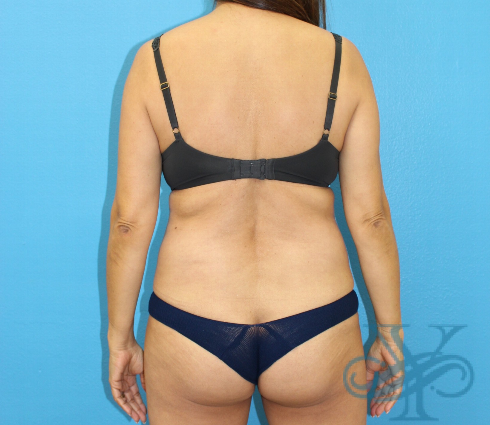 Before liposuction Dr. Yegiyants, Santa Barbara, CA