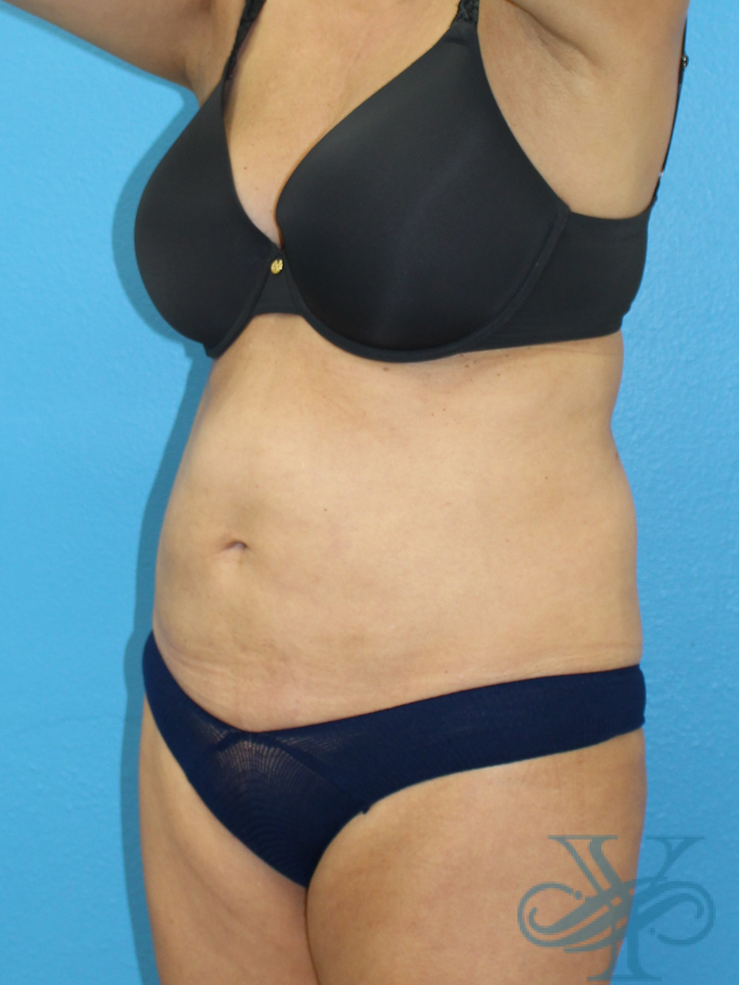 Before liposuction Dr. Yegiyants, Santa Barbara, CA