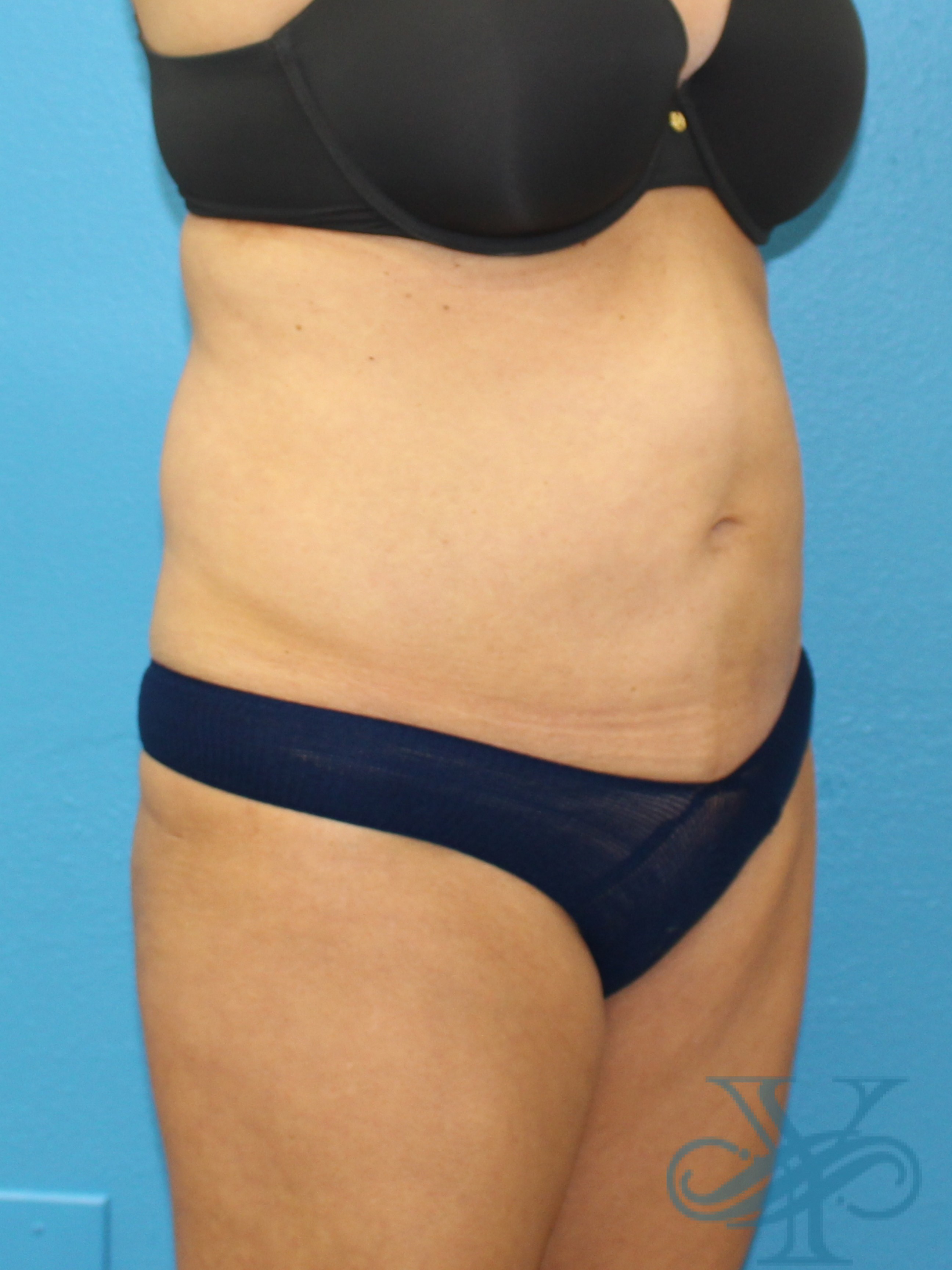 Before liposuction Dr. Yegiyants, Santa Barbara, CA