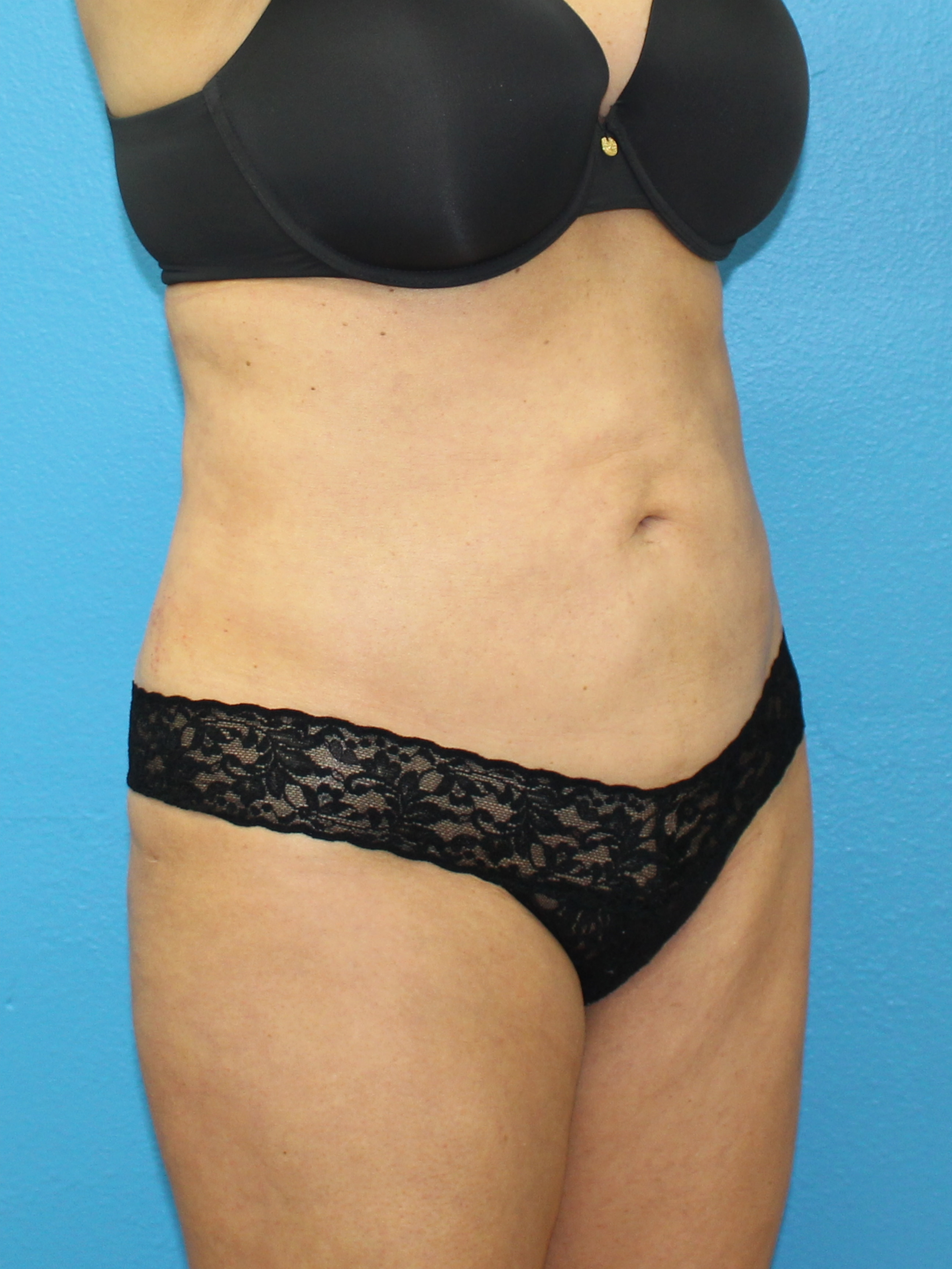 After liposuction Dr. Yegiyants, Santa Barbara, CA