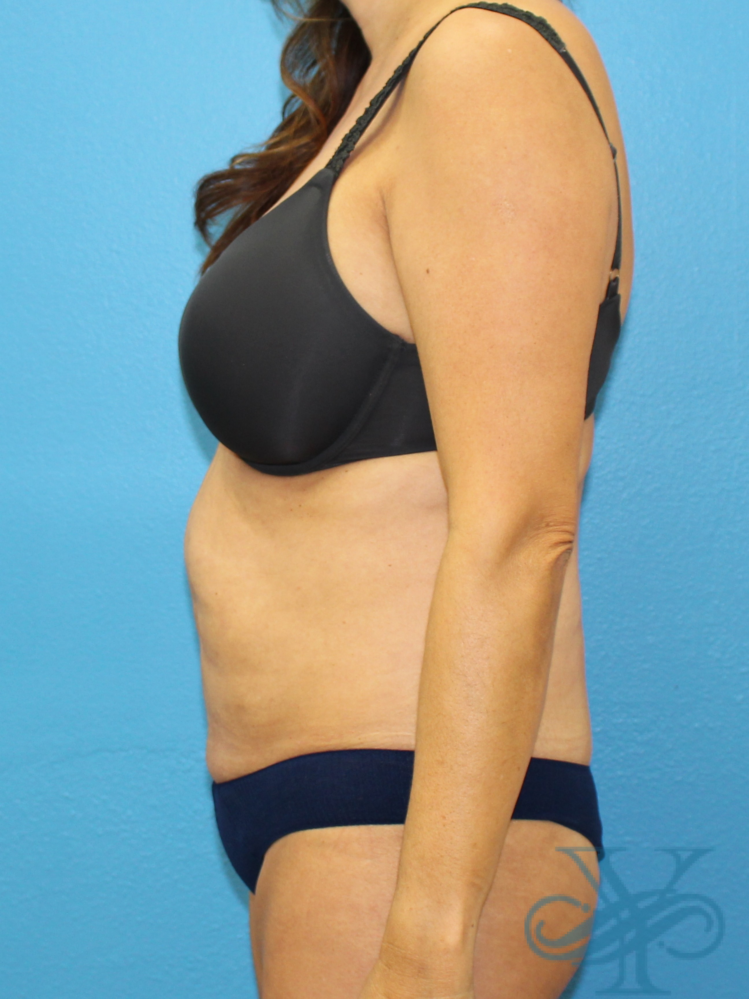 Before liposuction Dr. Yegiyants, Santa Barbara, CA
