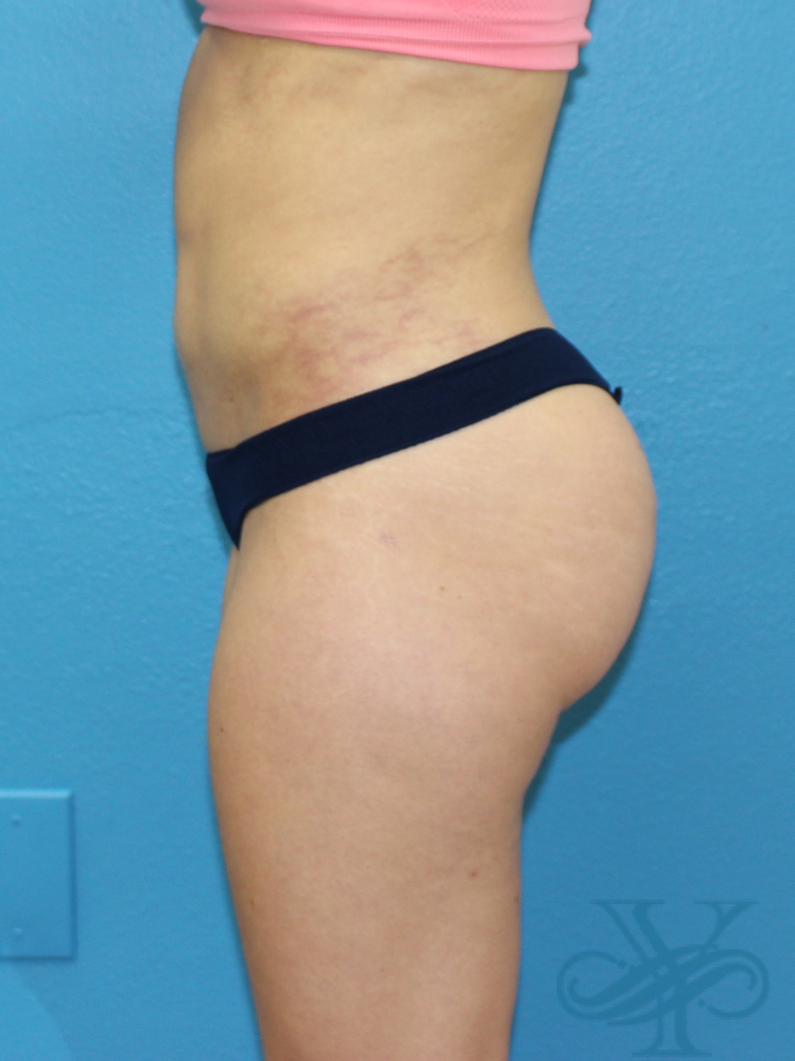 After liposuction revision Dr. Yegiyants, Santa Barabara, CA
