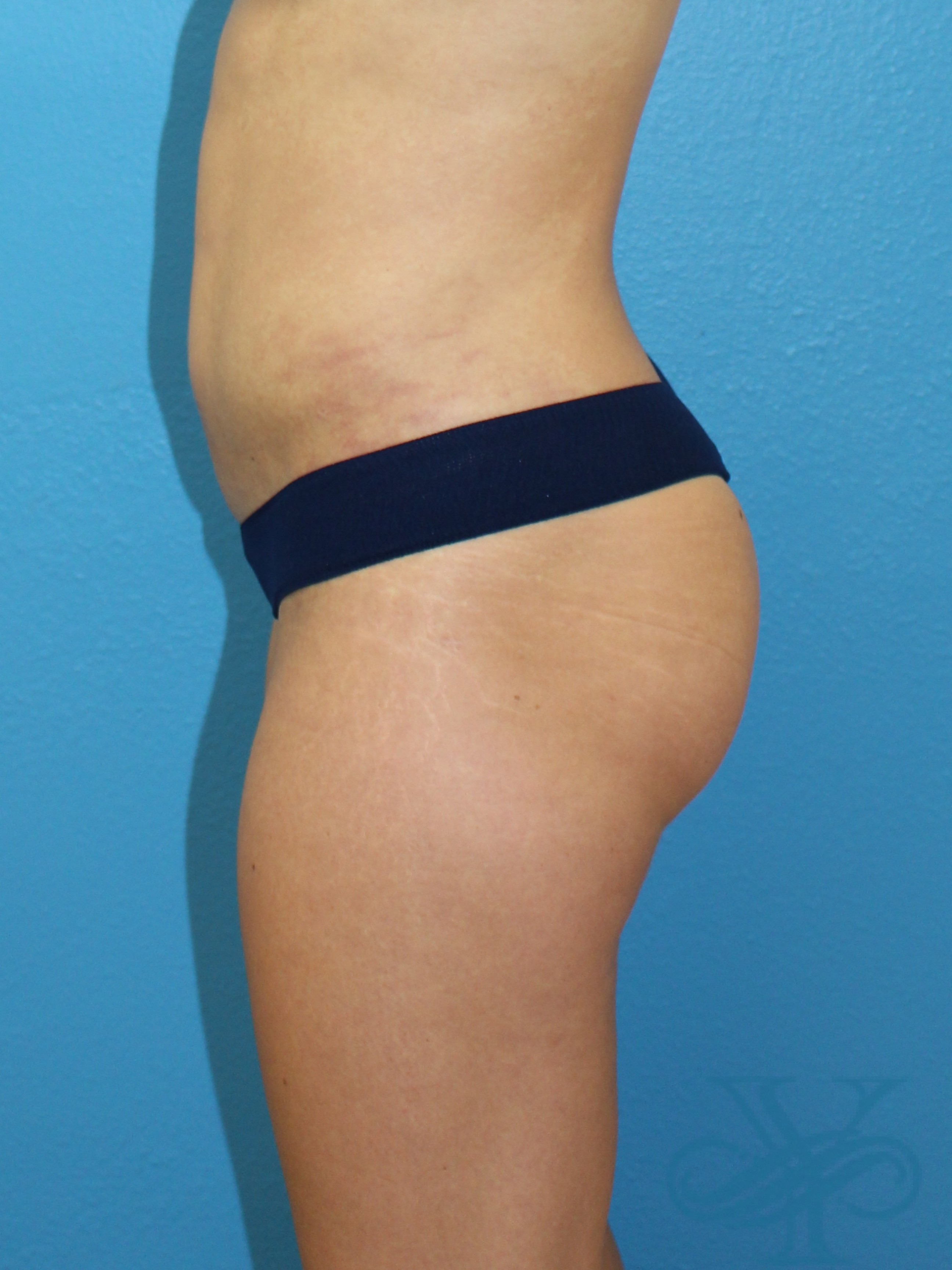 Before evision liposuction Dr. Yegiyants, Santa Barbara, CA