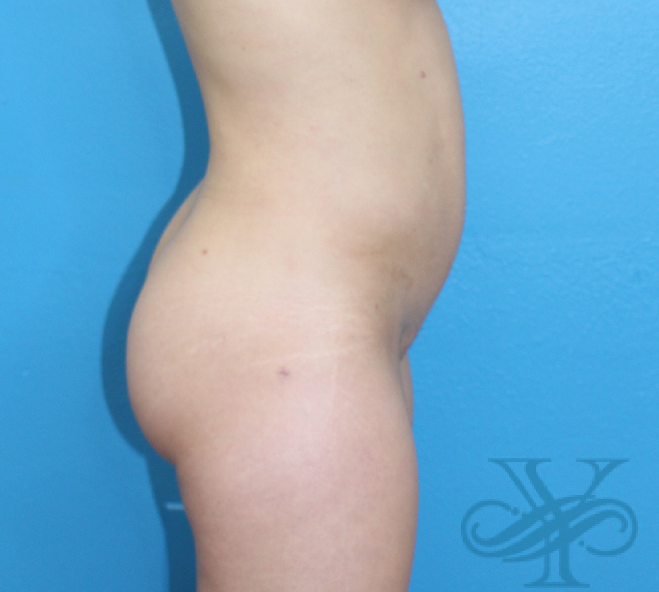 Before evision liposuction Dr. Yegiyants, Santa Barbara, CA