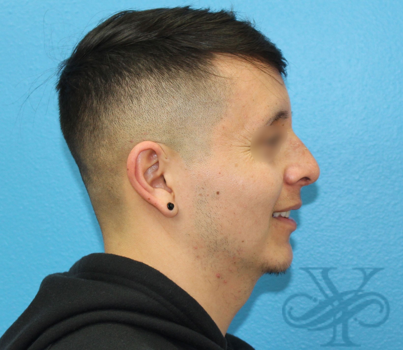 After rhinoplasty Dr. Yegiyants, Santa Barbara, CA