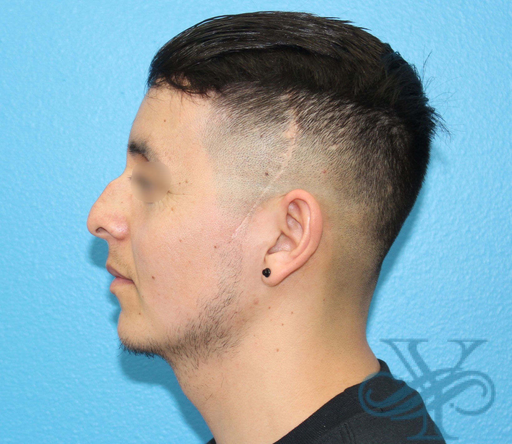 Before rhinoplasty Dr. Yegiyants, Santa Barbara, CA