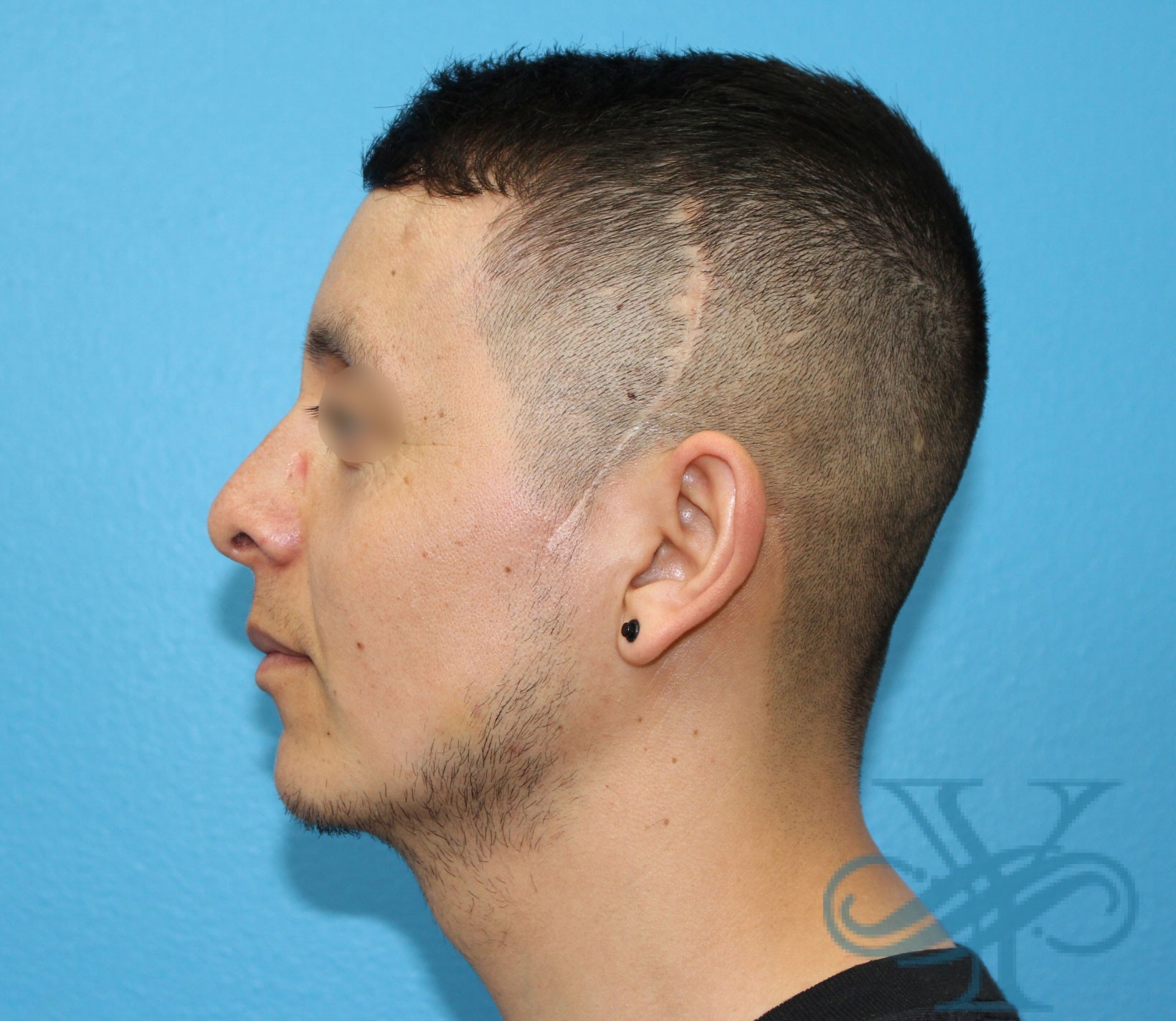 After rhinoplasty Dr. Yegiyants, Santa Barbara, CA