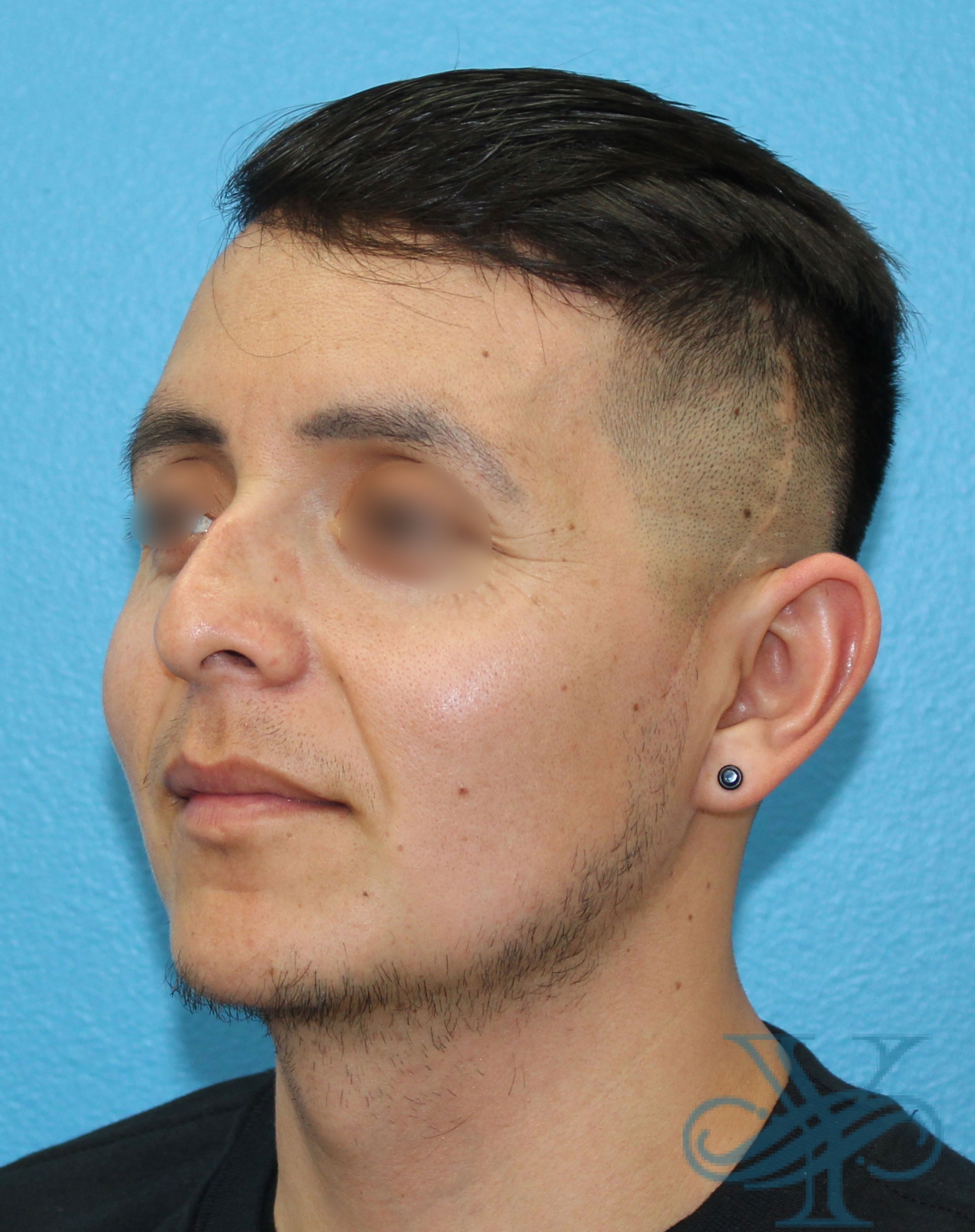 Before rhinoplasty Dr. Yegiyants, Santa Barbara, CA