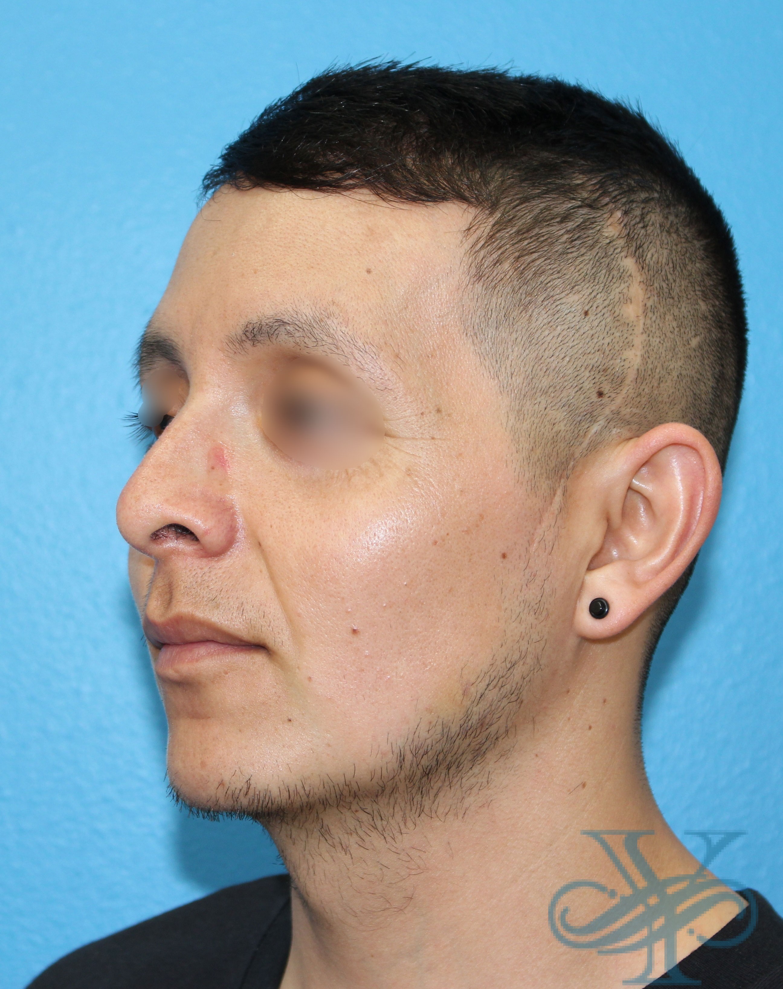 After rhinoplasty Dr. Yegiyants, Santa Barbara, CA