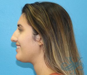 Before rhinoplasty Dr. Yegiyants, Santa Barbara, CA