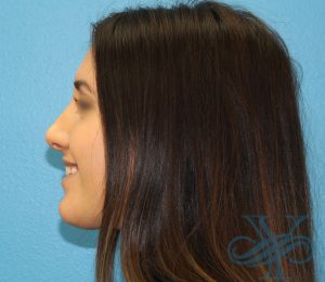 After rhinoplasty Dr. Yegiyants, Santa Barbara, CA