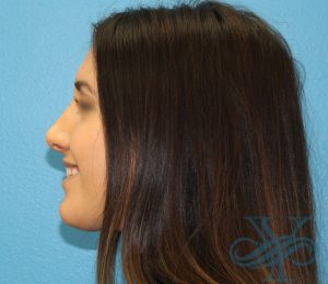 After rhinoplasty Dr. Yegiyants, Santa Barbara, CA