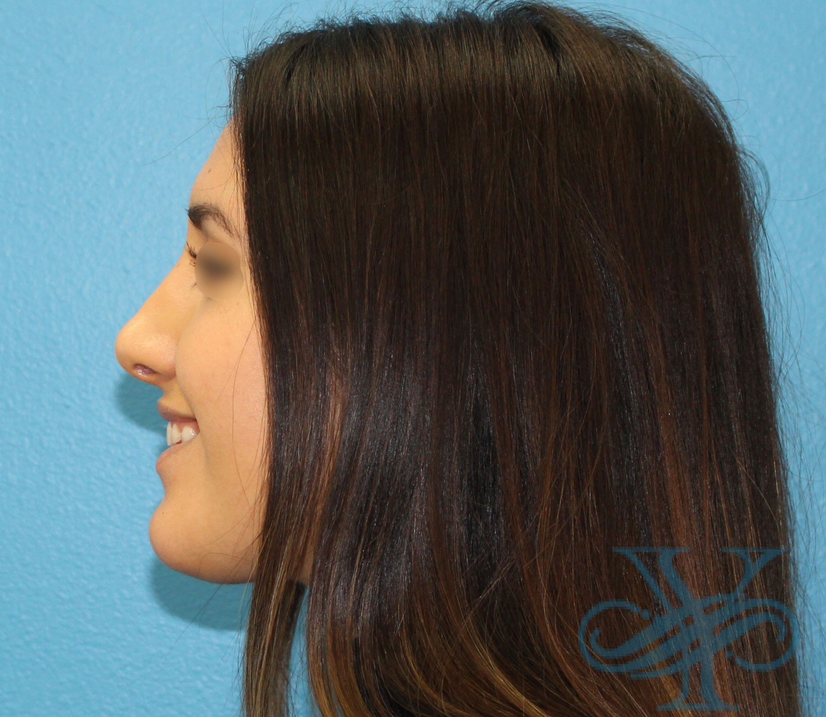 After rhinoplasty Dr. Yegiyants, Santa Barbara, CA