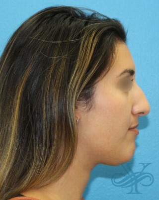 Before rhinoplasty Dr. Yegiyants, Santa Barbara, CA
