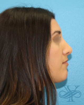 After rhinoplasty Dr. Yegiyants, Santa Barbara, CA