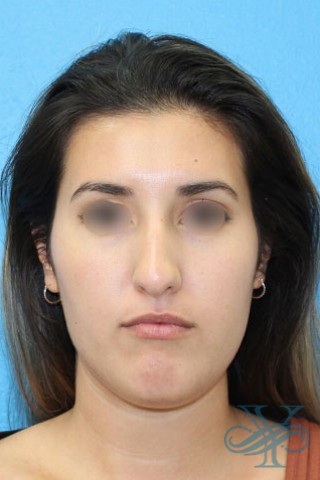 Before rhinoplasty Dr. Yegiyants, Santa Barbara, CA