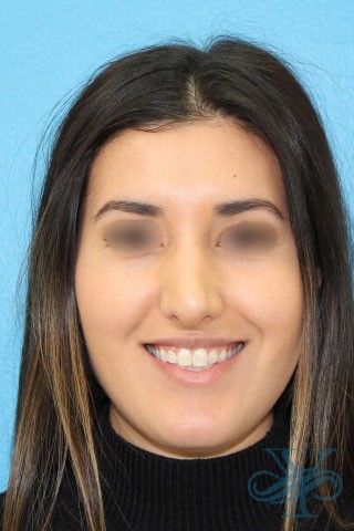 After rhinoplasty Dr. Yegiyants, Santa Barbara, CA