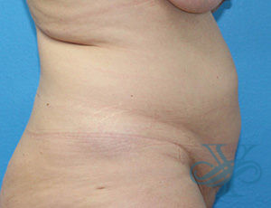 Before abdominoplasty Dr. Yegiyants, Santa Barbara, CA