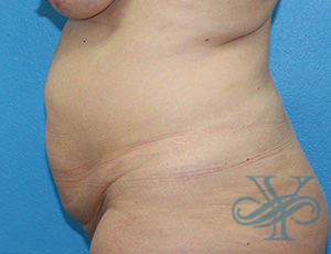 Before abdominoplasty Dr. Yegiyants, Santa Barbara, CA