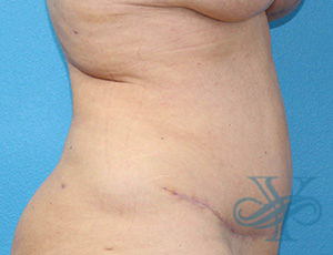 After abdominoplasty Dr. Yegiyants, Santa Barbara, CA