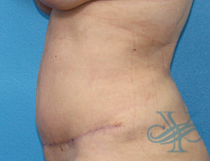 After abdominoplasty Dr. Yegiyants, Santa Barbara, CA