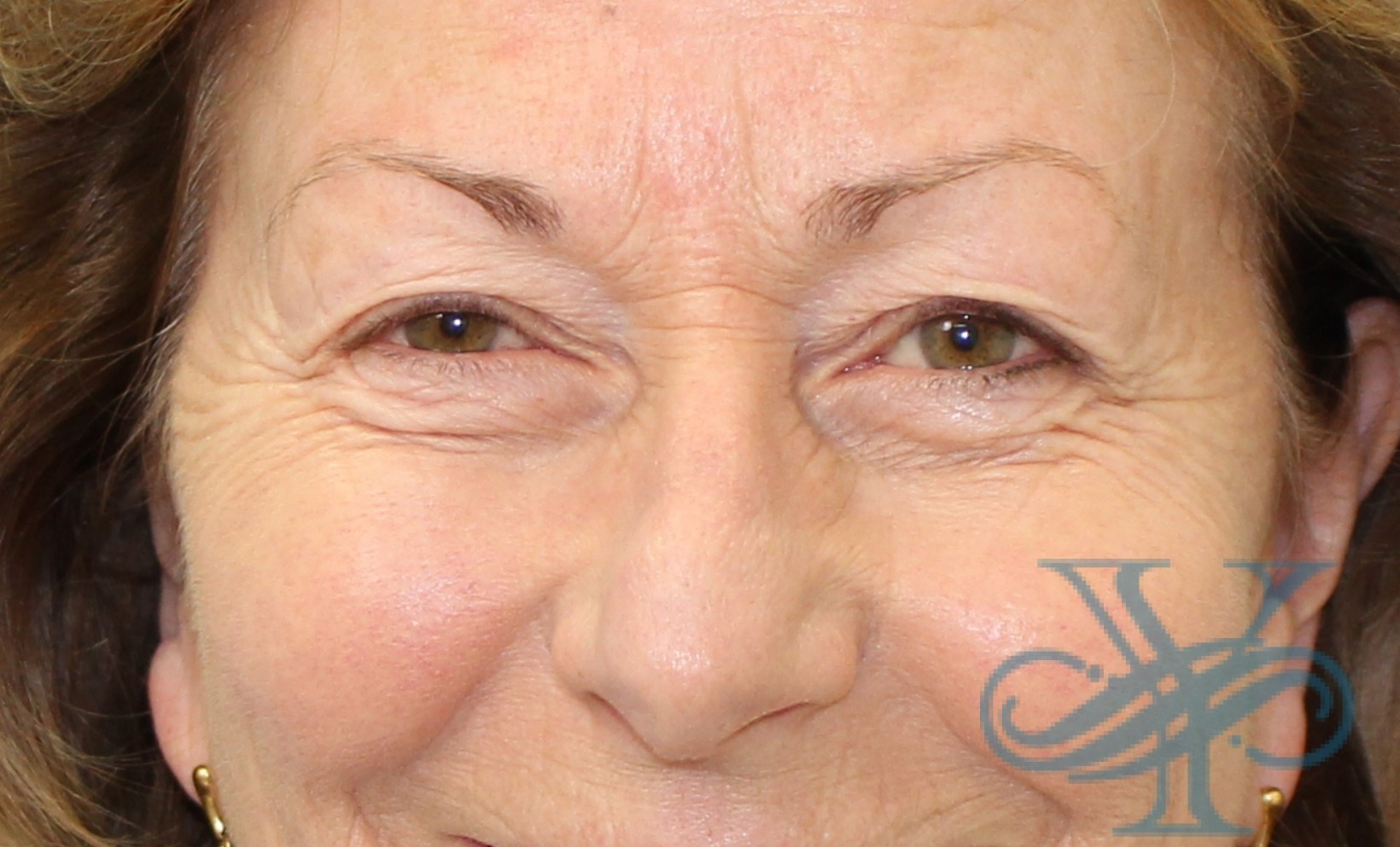 Before blepharoplasty Dr. Yegiyants, Santa Barbara, CA