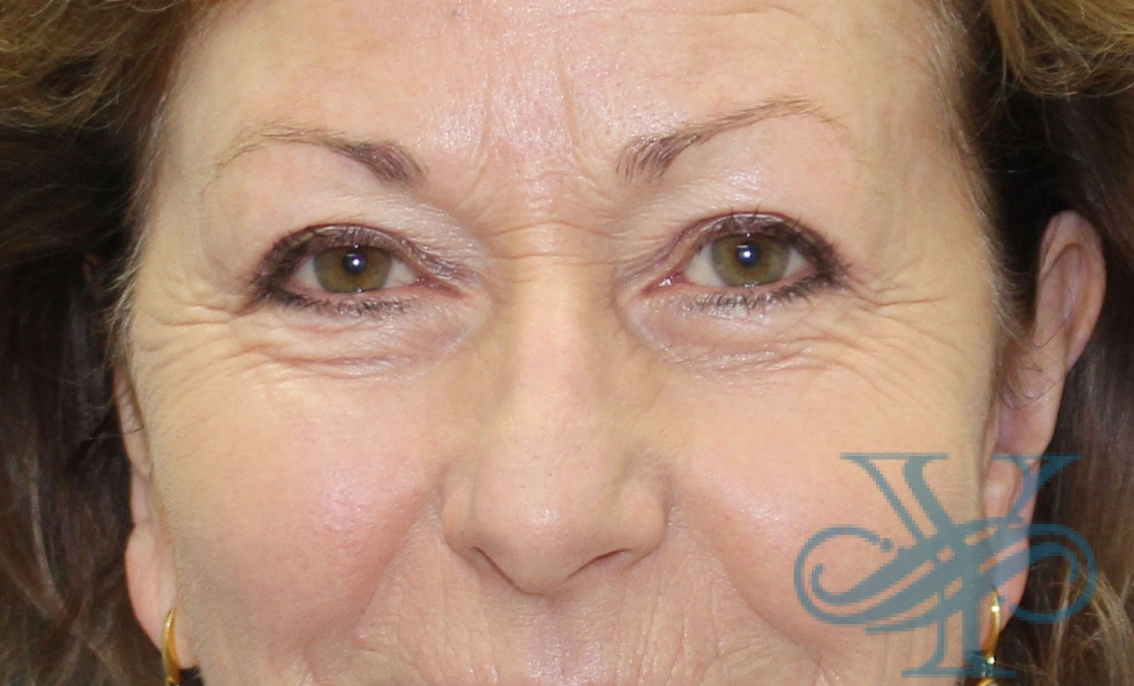 After blepharoplasty Dr. Yegiyants, Santa Barbara, CA