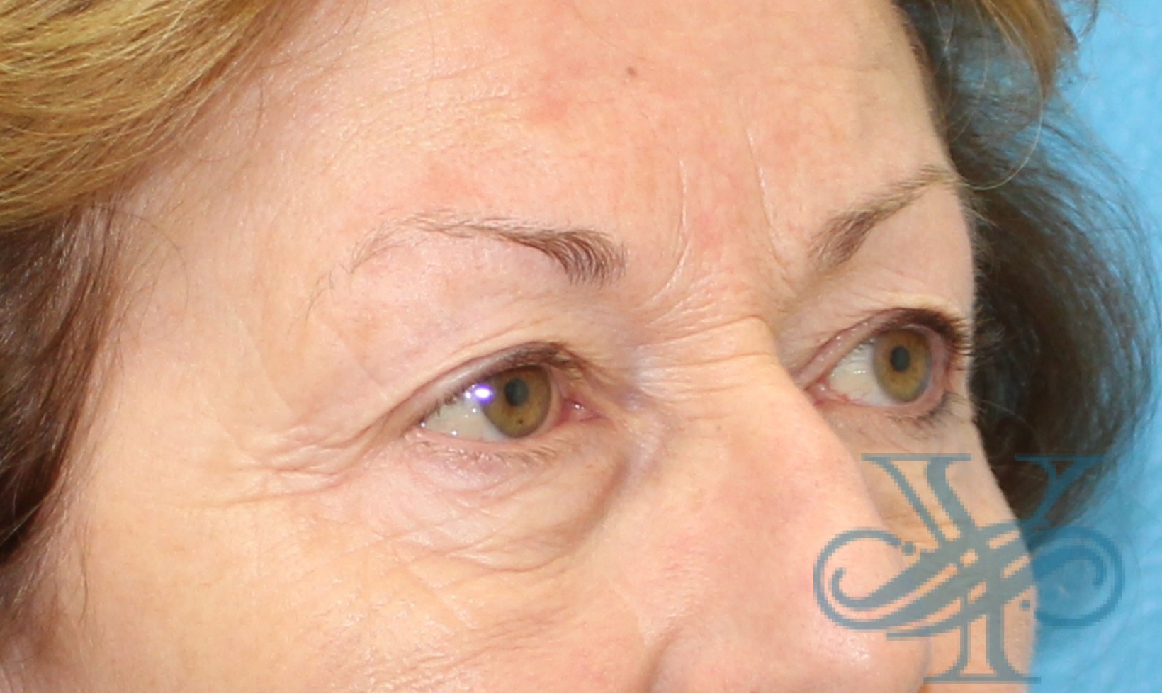 Before blepharoplasty Dr. Yegiyants, Santa Barbara, CA