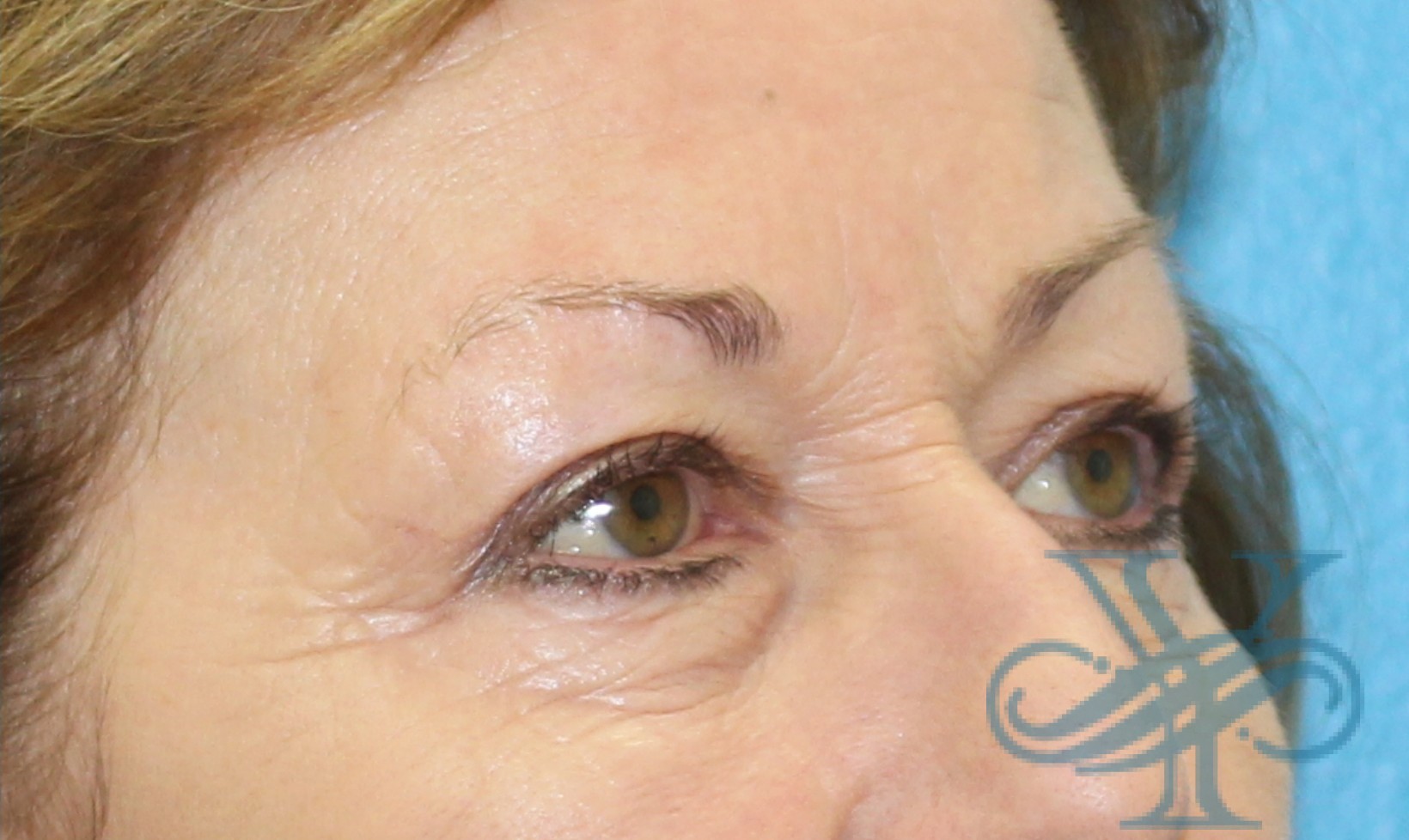 After blepharoplasty Dr. Yegiyants, Santa Barbara, CA