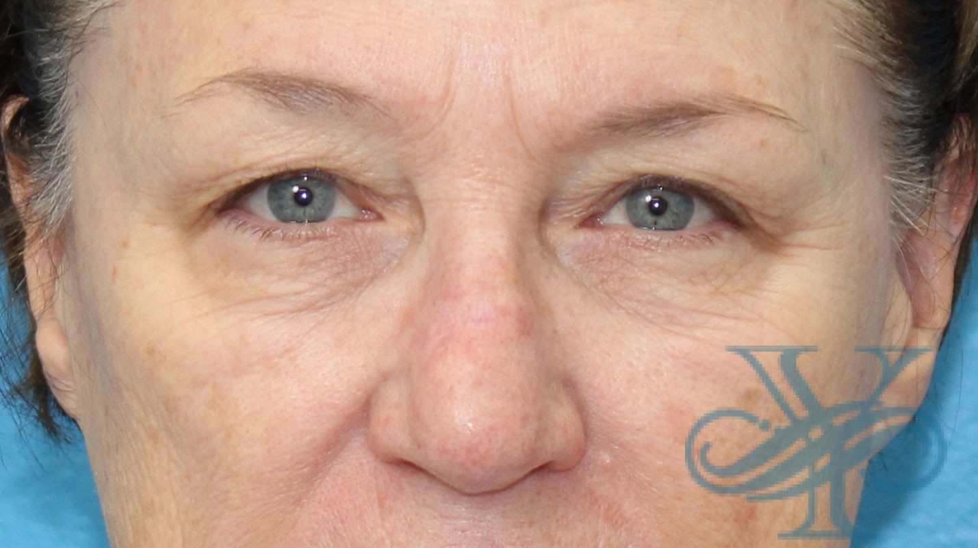 Before blepharoplasty Dr. Yegiyants, Santa Barbara, CA