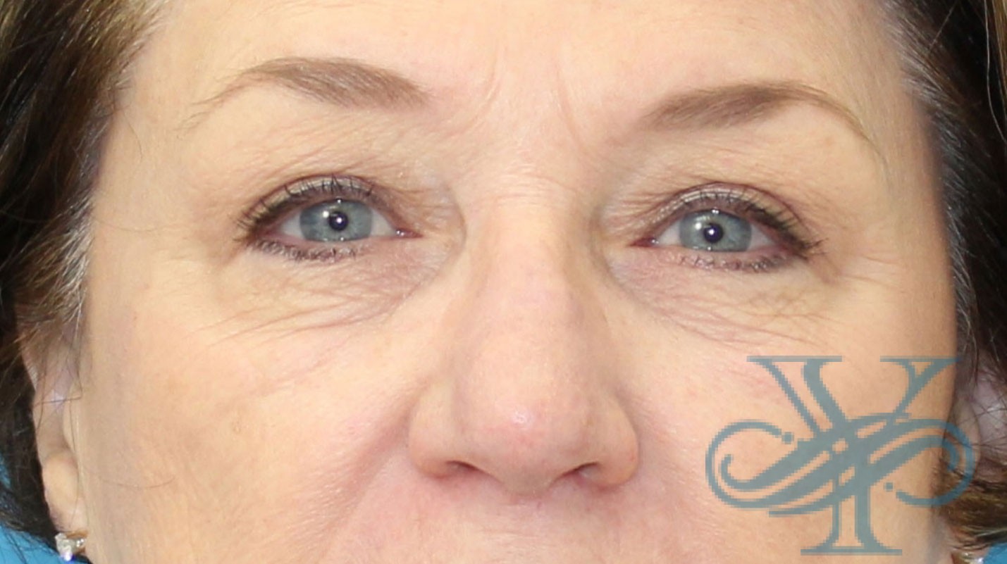 After blepharoplasty Dr. Yegiyants, Santa Barbara, CA