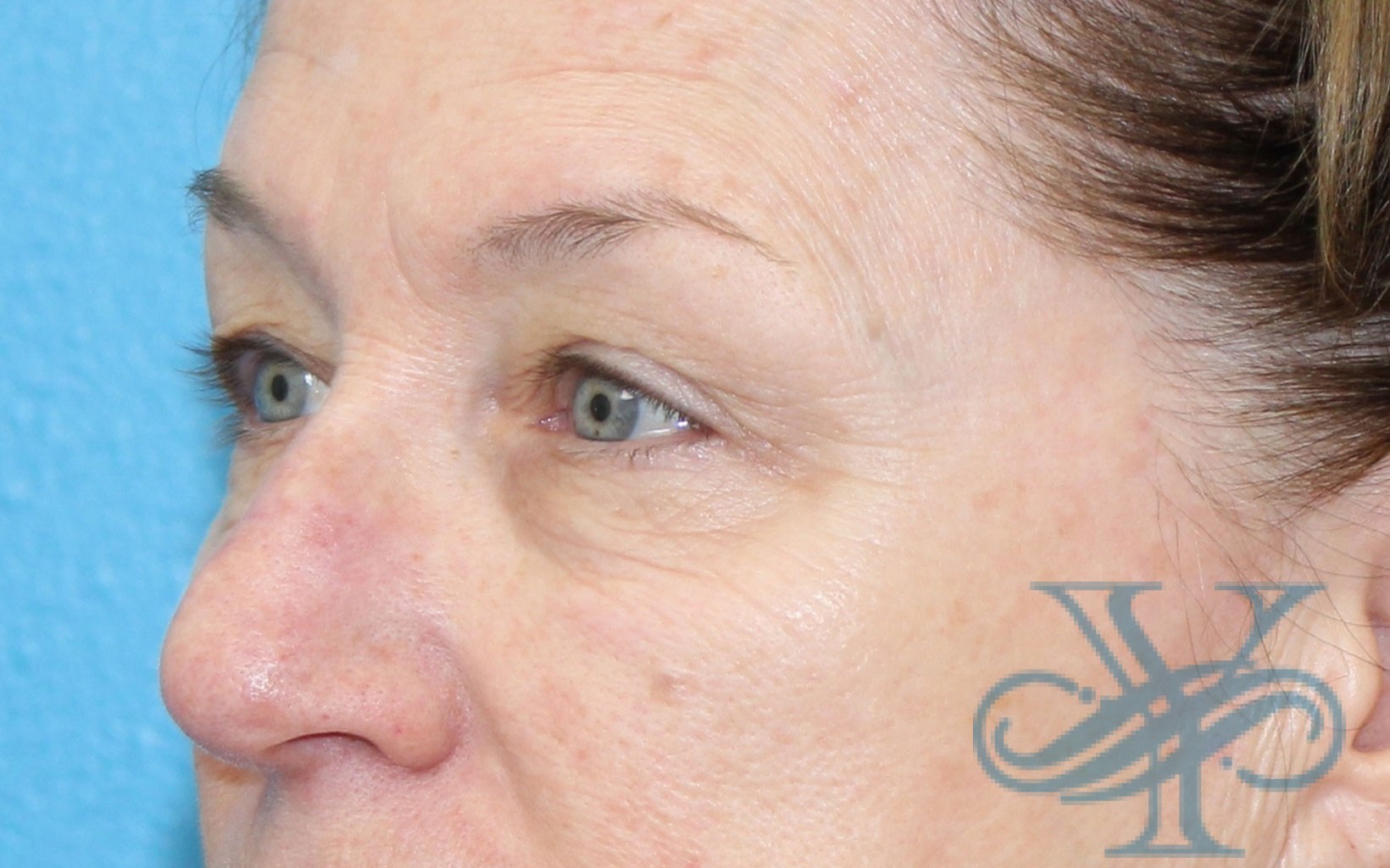 Before blepharoplasty Dr. Yegiyants, Santa Barbara, CA