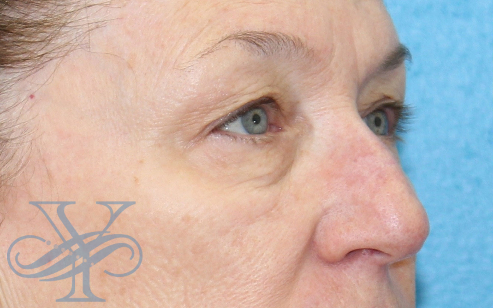 Before blepharoplasty Dr. Yegiyants, Santa Barbara, CA