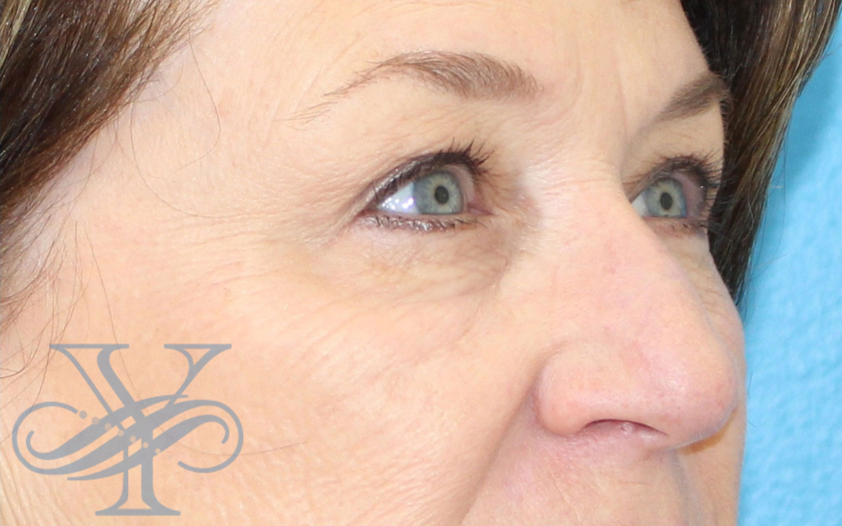After blepharoplasty Dr. Yegiyants, Santa Barbara, CA