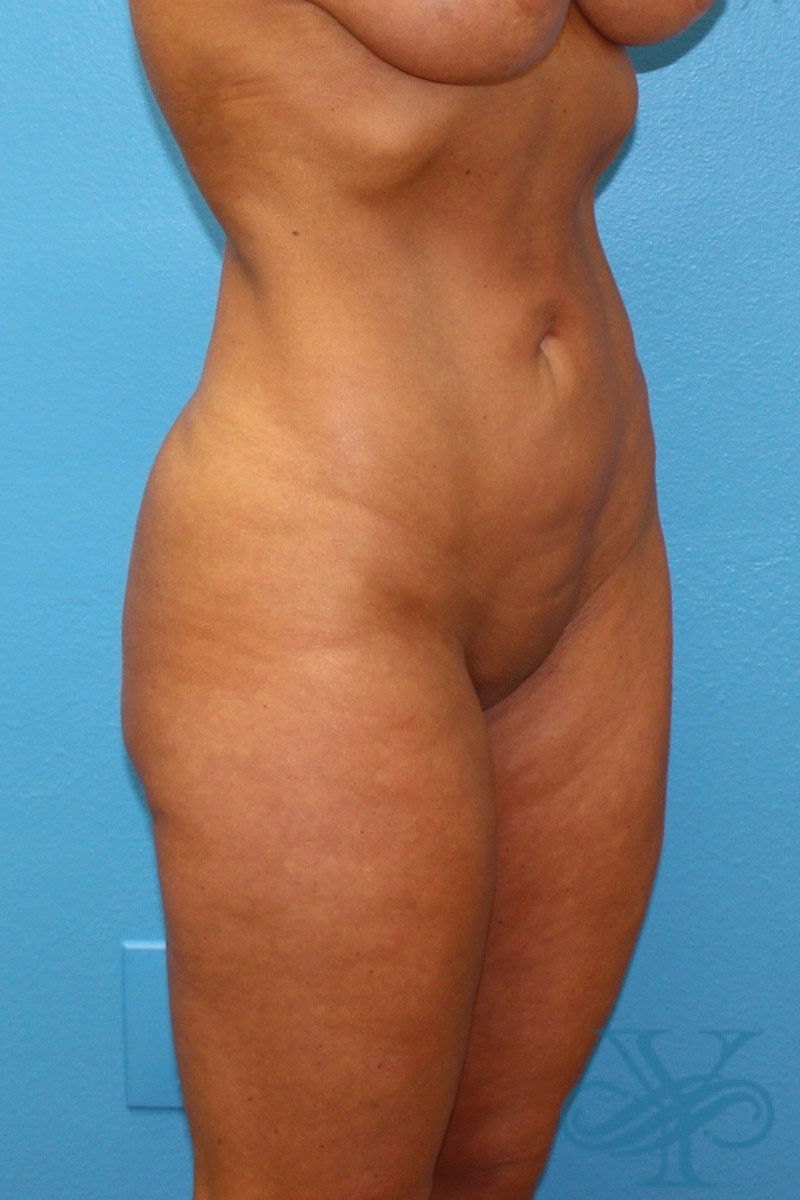 After brazilian butt lift liposuction Dr. Yegiyants, Santa Barbara, CA