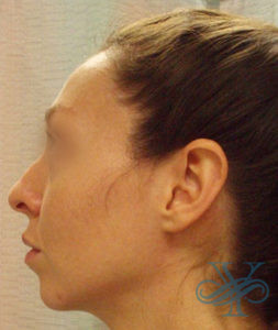 Before rhinoplasty Dr. Yegiyants, Santa Barbara, CA