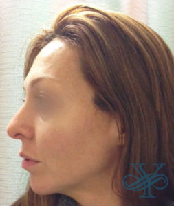 After rhinoplasty Dr. Yegiyants, Santa Barbara, CA