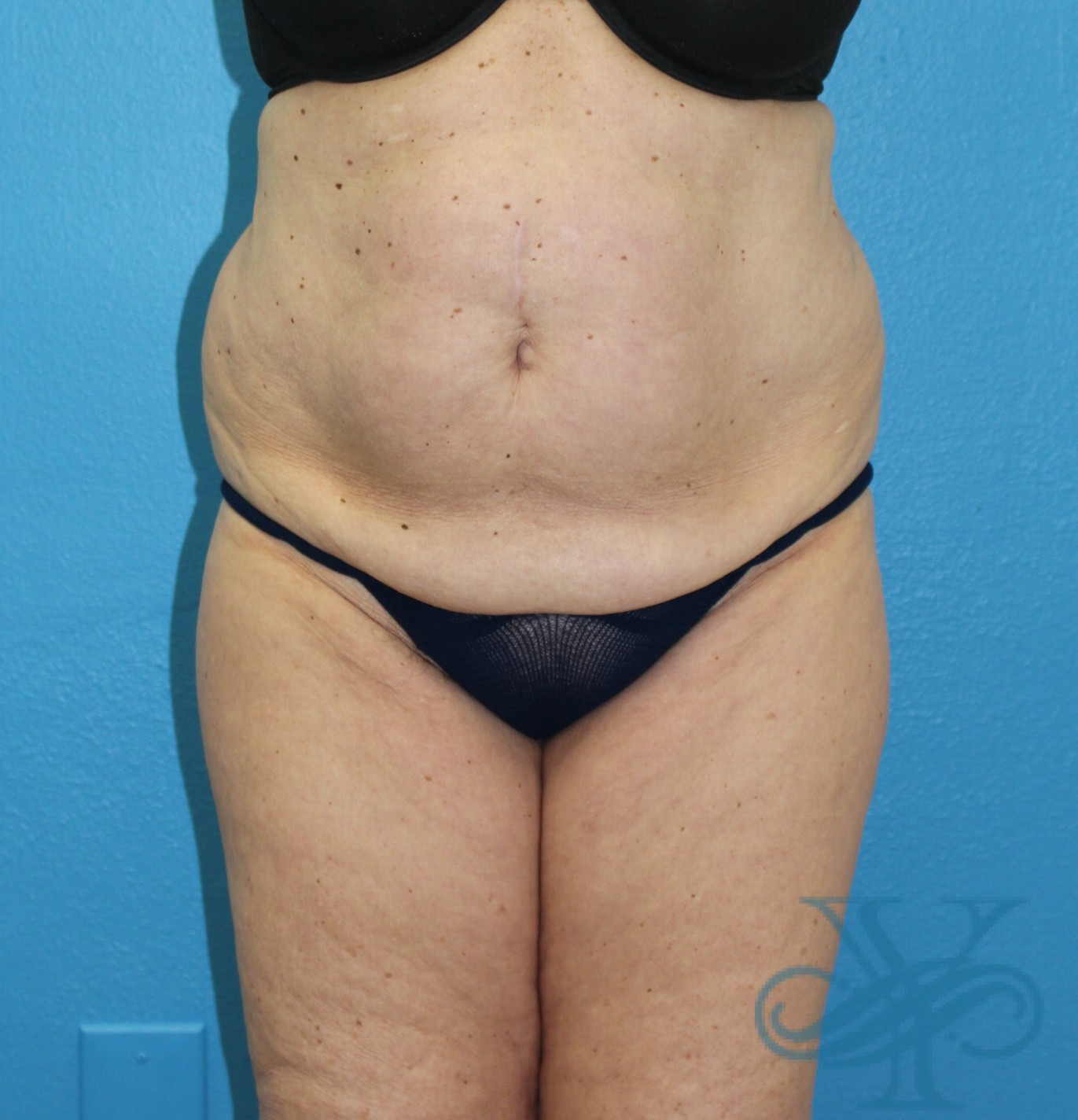 Before coolsculpting Dr. Yegiyants, Santa Barbara, CA