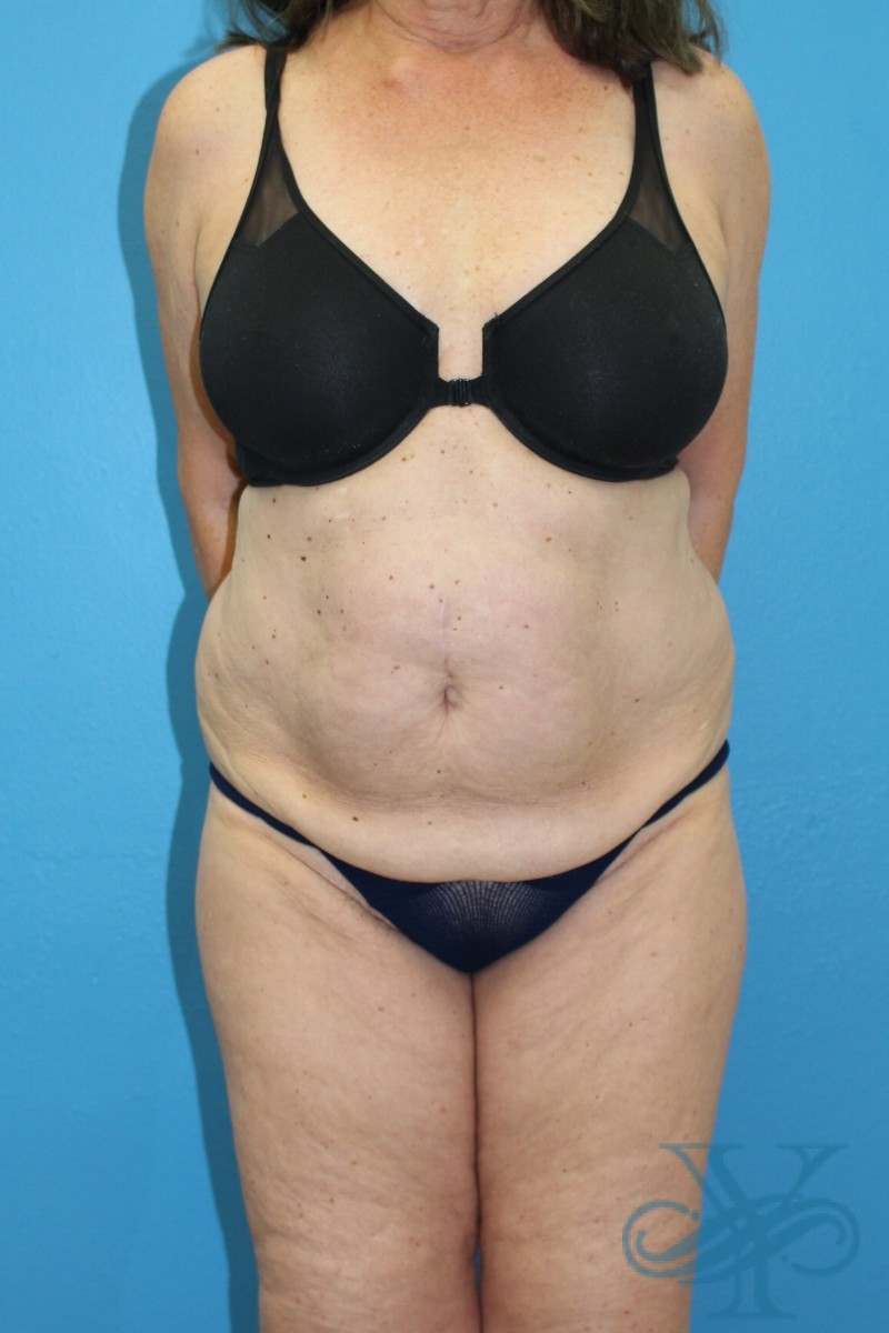 Before coolsculpting Dr. Yegiyants, Santa Barbara, CA