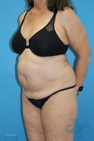 Before coolsculpting Dr. Yegiyants, Santa Barbara, CA