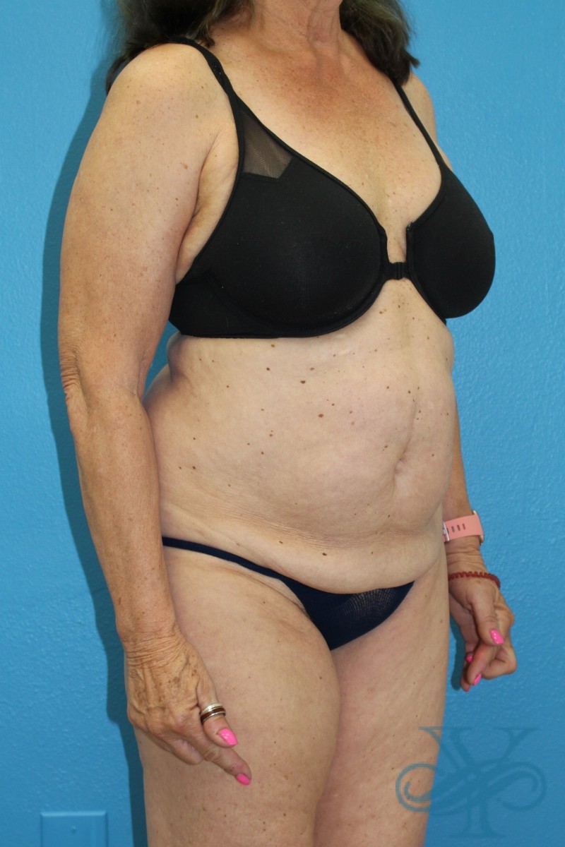 Before coolsculpting Dr. Yegiyants, Santa Barbara, CA