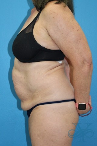 Before coolsculpting Dr. Yegiyants, Santa Barbara, CA