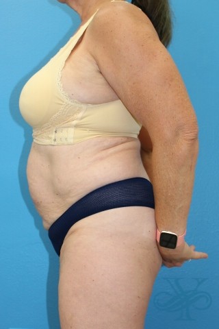 After coolsculpting Dr. Yegiyants, Santa Barbara, CA