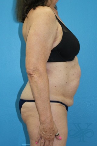 Before coolsculpting Dr. Yegiyants, Santa Barbara, CA