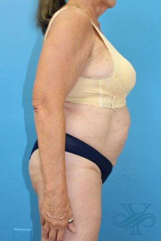 After coolsculpting Dr. Yegiyants, Santa Barbara, CA