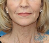 Before facelift and necklift Dr. Yegiyants, Santa Barbara, CA
