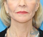 After facelift necklift Dr. Yegiyants, Santa Barbara, Ca